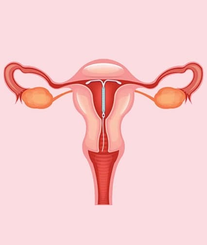 Intrauterine Contraceptive Device(IUCD)