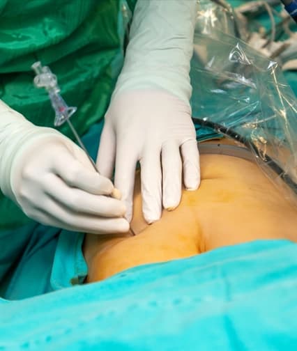 laparoscopic-ovarian-cystectomy